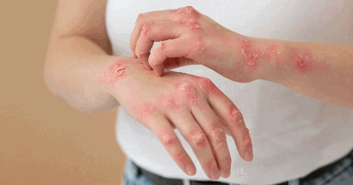 Natural Remedies To Combat Eczema: What Works And What Doesn’t