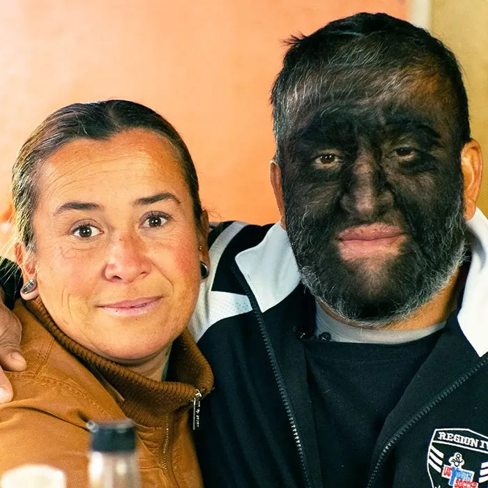 Hypertrichosis