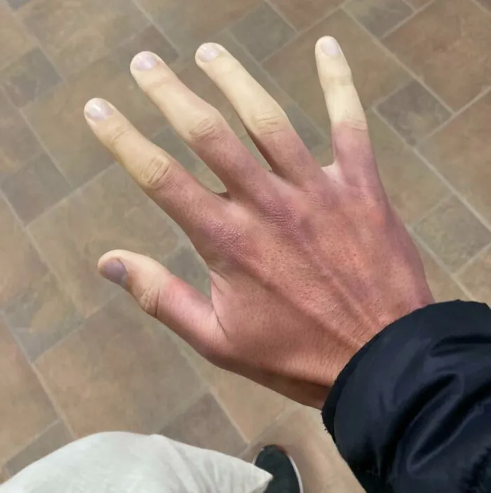 Raynaud’s Disease