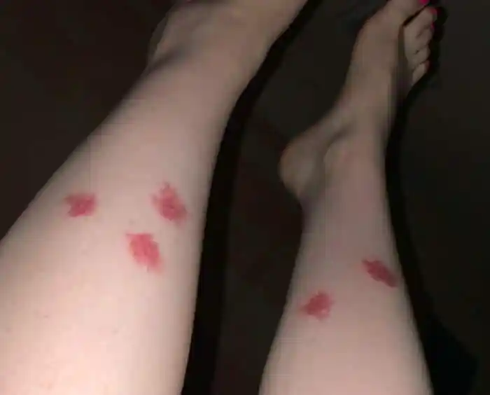 Skeeter Syndrome