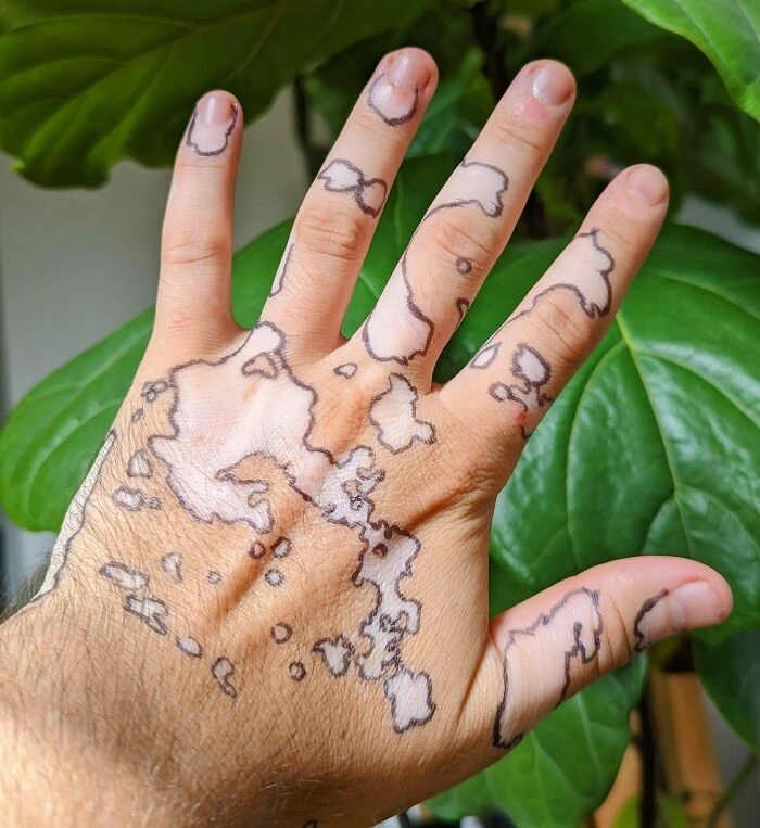 Vitiligo Spots
